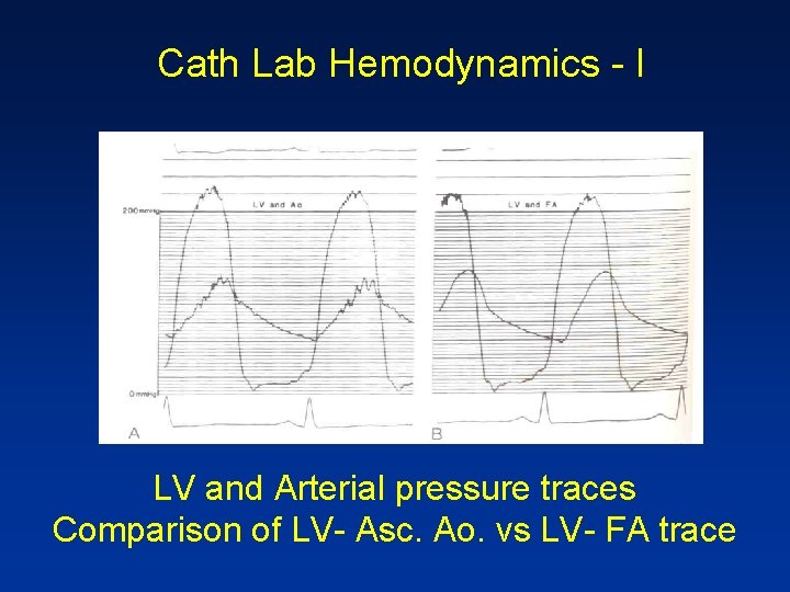 Cath Lab Hemodynamics - I LV and Arterial pressure traces Comparison of LV- Asc.