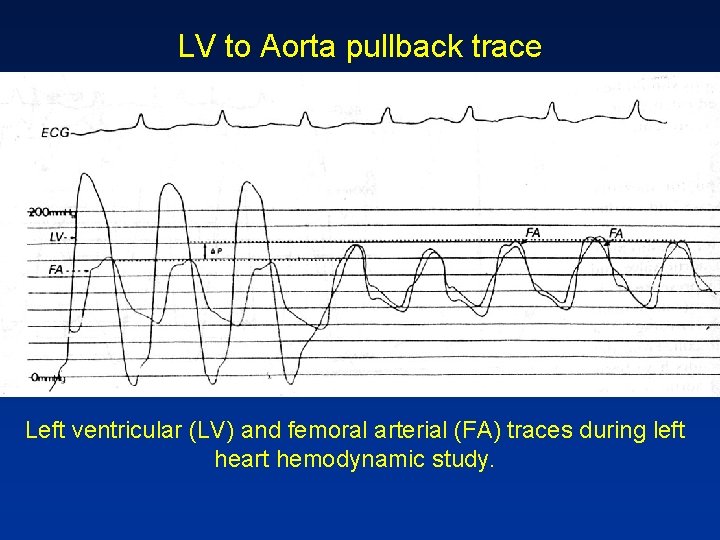 LV to Aorta pullback trace Left ventricular (LV) and femoral arterial (FA) traces during