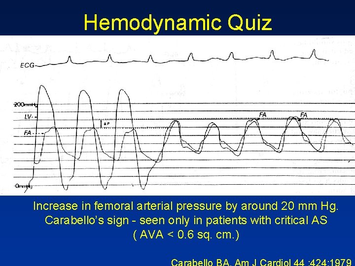 Hemodynamic Quiz Increase in femoral arterial pressure by around 20 mm Hg. Carabello’s sign