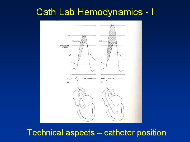 Cath Lab Hemodynamics - I Technical aspects – catheter position 