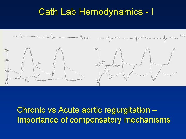 Cath Lab Hemodynamics - I Chronic vs Acute aortic regurgitation – Importance of compensatory