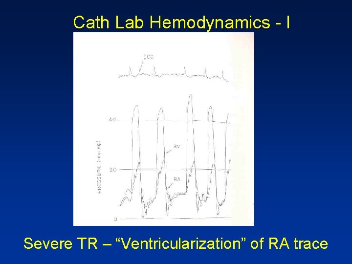 Cath Lab Hemodynamics - I Severe TR – “Ventricularization” of RA trace 