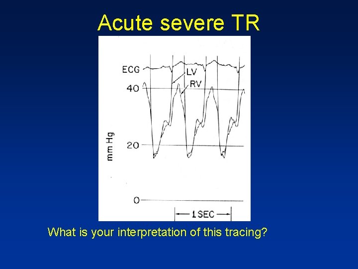 Acute severe TR What is your interpretation of this tracing? 