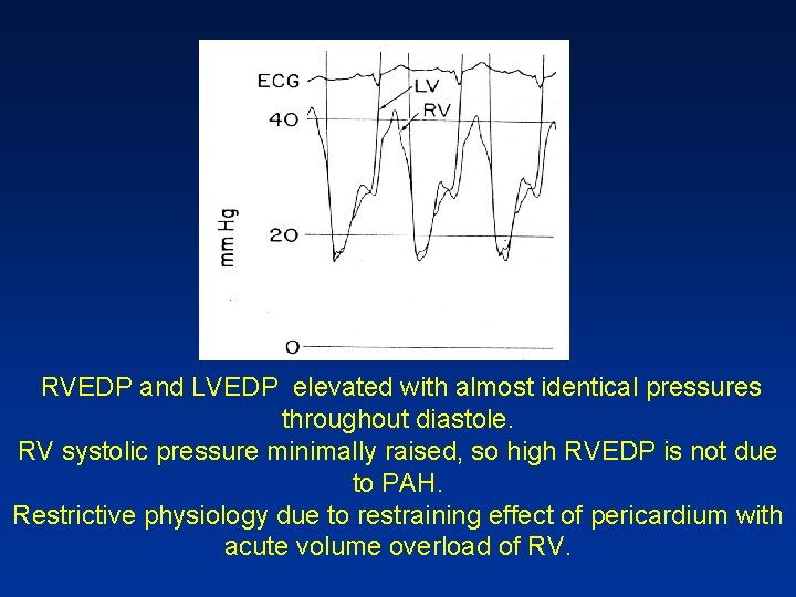  RVEDP and LVEDP elevated with almost identical pressures throughout diastole. RV systolic pressure