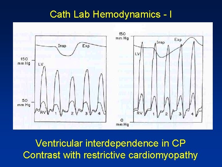 Cath Lab Hemodynamics - I Ventricular interdependence in CP Contrast with restrictive cardiomyopathy 