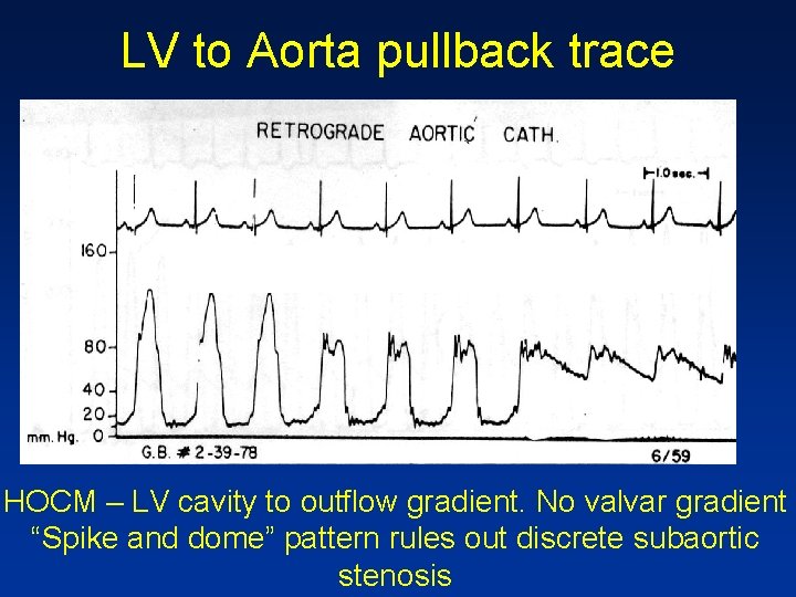 LV to Aorta pullback trace HOCM – LV cavity to outflow gradient. No valvar