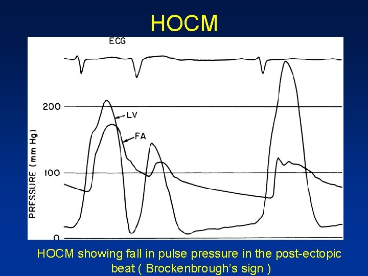 HOCM showing fall in pulse pressure in the post-ectopic beat ( Brockenbrough’s sign )