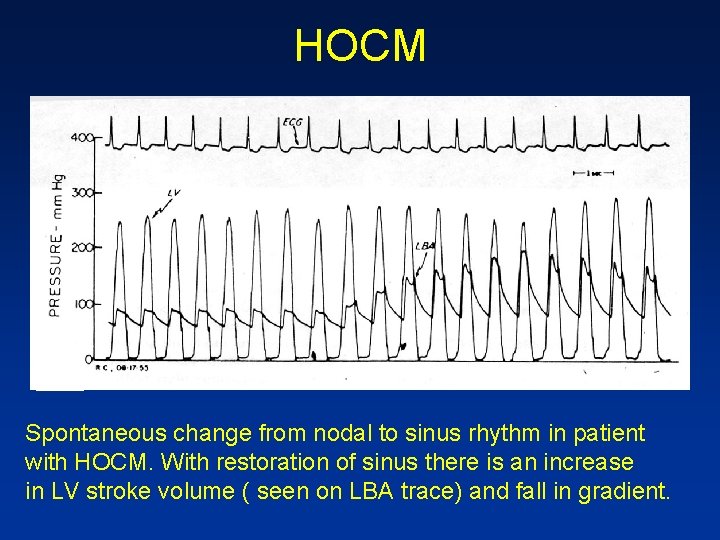 HOCM Spontaneous change from nodal to sinus rhythm in patient with HOCM. With restoration