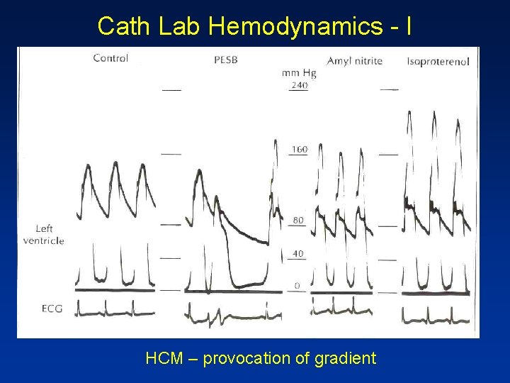 Cath Lab Hemodynamics - I HCM – provocation of gradient 