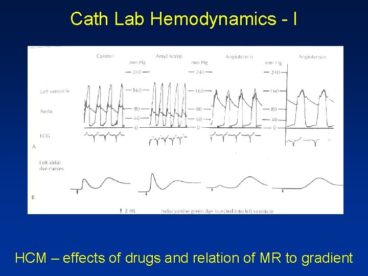 Cath Lab Hemodynamics - I HCM – effects of drugs and relation of MR