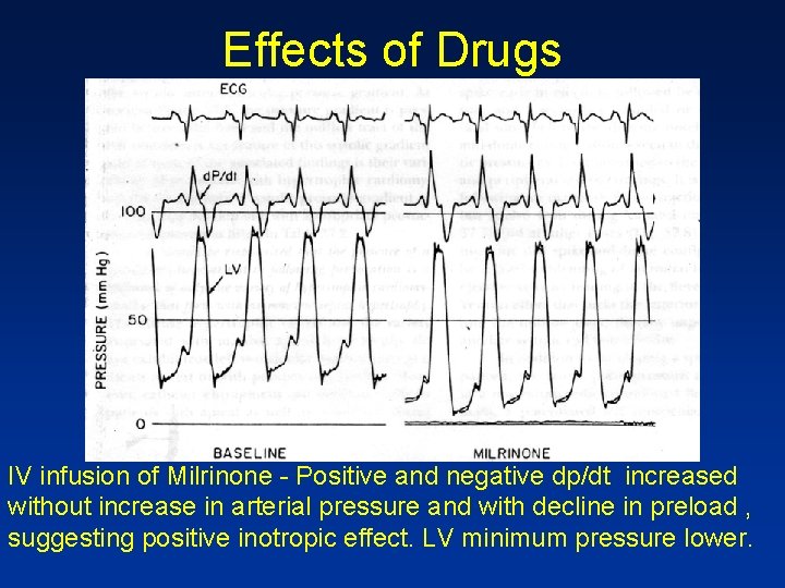 Effects of Drugs IV infusion of Milrinone - Positive and negative dp/dt increased without