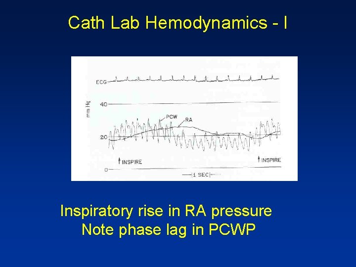 Cath Lab Hemodynamics - I Inspiratory rise in RA pressure Note phase lag in
