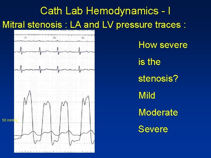 Cath Lab Hemodynamics - I Mitral stenosis : LA and LV pressure traces :