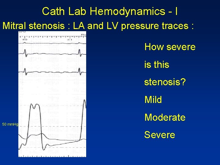 Cath Lab Hemodynamics - I Mitral stenosis : LA and LV pressure traces :