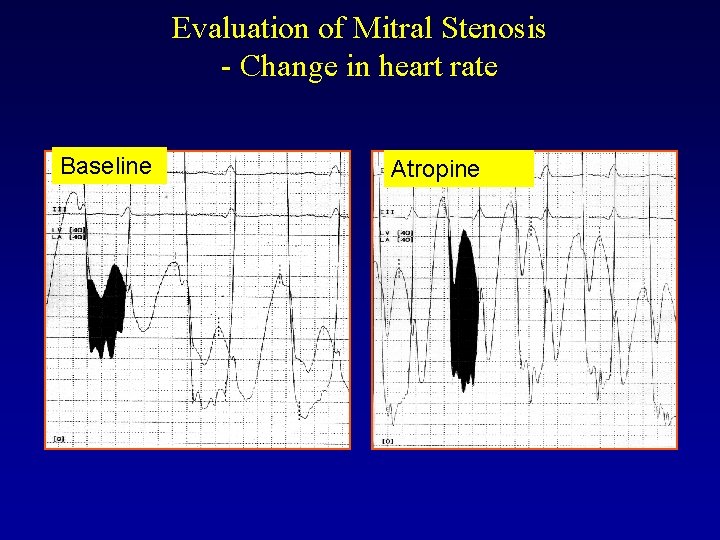 Evaluation of Mitral Stenosis - Change in heart rate Baseline Atropine 