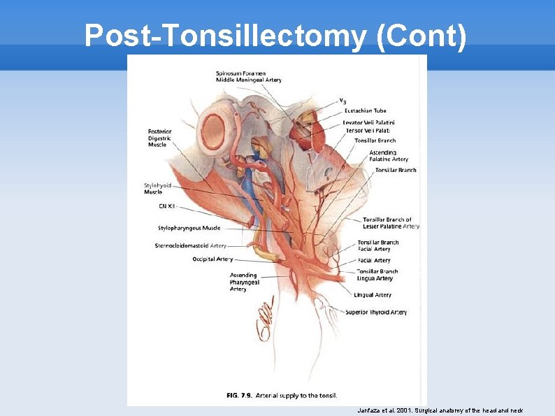 Post-Tonsillectomy (Cont) Janfaza et al. 2001. Surgical anatomy of the head and neck 