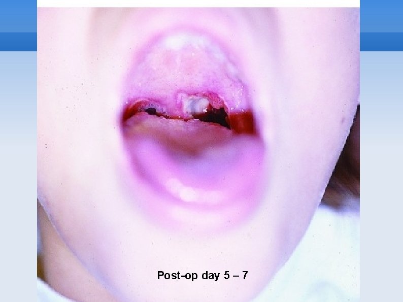 Post-Tonsillectomy (Cont) Post-op day 5 – 7 