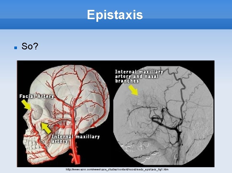 Epistaxis So? http: //www. esnr. com/www/case_studies/content/nosebleeds_epistaxis_fig 1. htm 