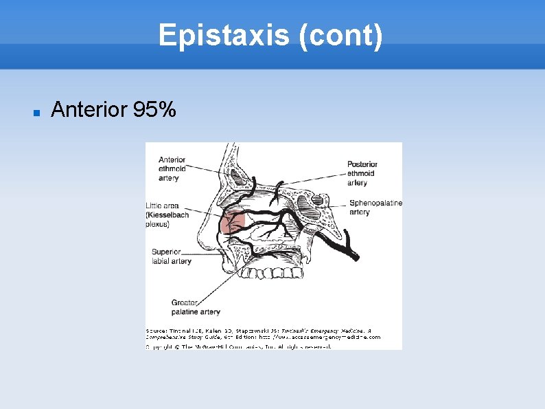 Epistaxis (cont) Anterior 95% 