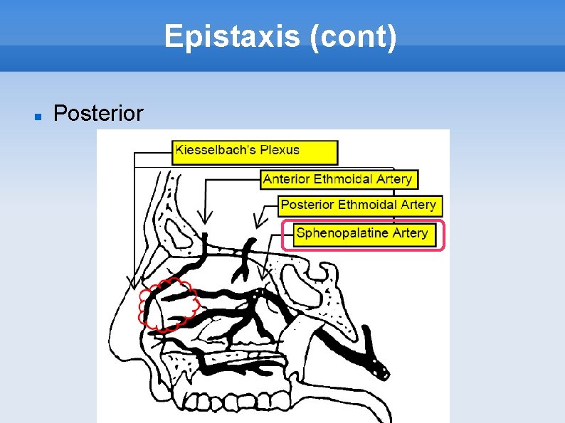 Epistaxis (cont) Posterior 