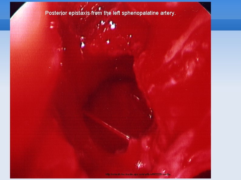 Posterior epistaxis from the left sphenopalatine artery. http: //emedicine. medscape. com/article/863220 -media 