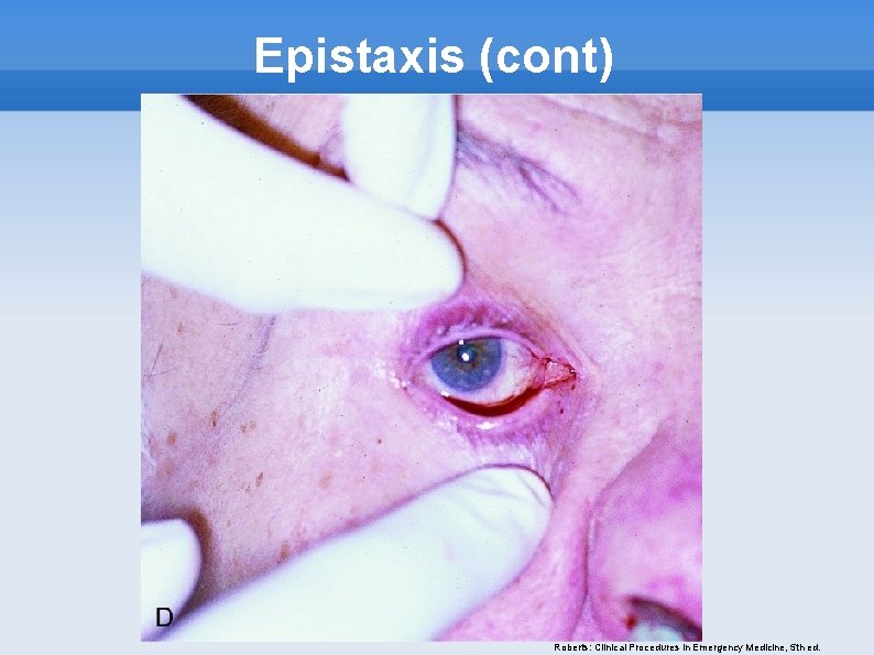 Epistaxis (cont) Roberts: Clinical Procedures in Emergency Medicine, 5 th ed. 