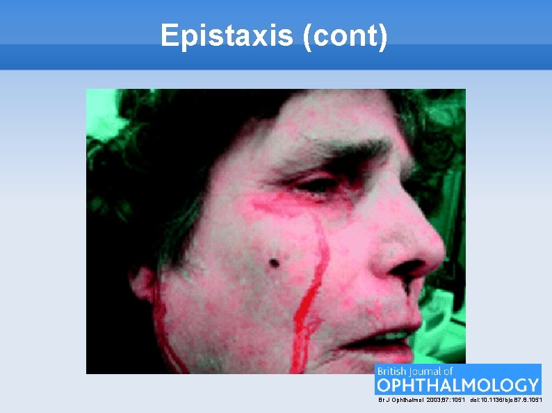 Epistaxis (cont) Br J Ophthalmol 2003; 87: 1051 doi: 10. 1136/bjo. 87. 8. 1051