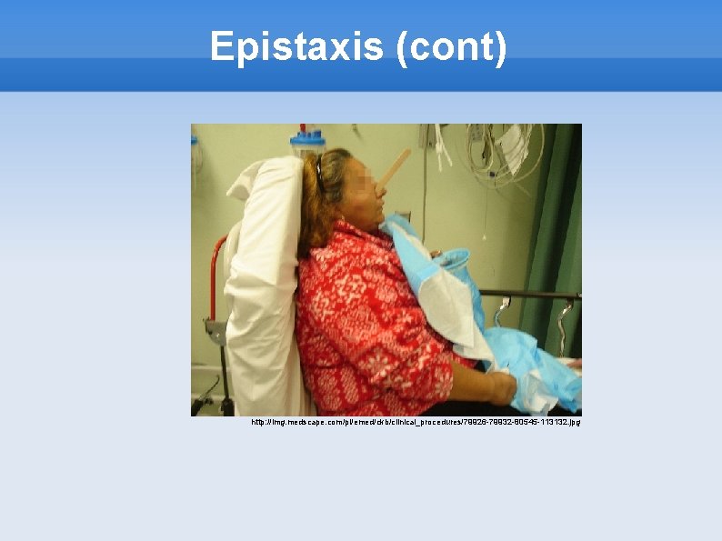 Epistaxis (cont) http: //img. medscape. com/pi/emed/ckb/clinical_procedures/79926 -79932 -80545 -113132. jpg 