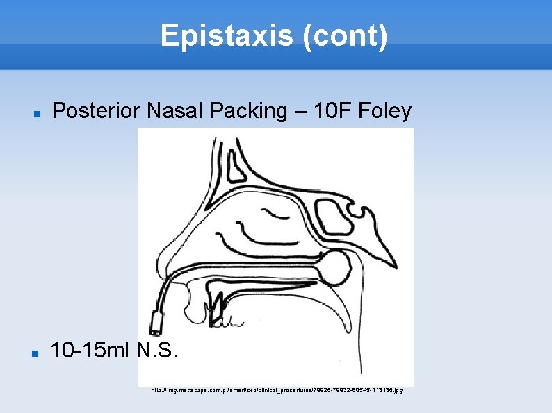 Epistaxis (cont) Posterior Nasal Packing – 10 F Foley 10 -15 ml N. S.