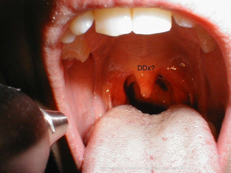 DDx? http: //meded. ucsd. edu/clinicalimg/head_pharyngitis. htm 