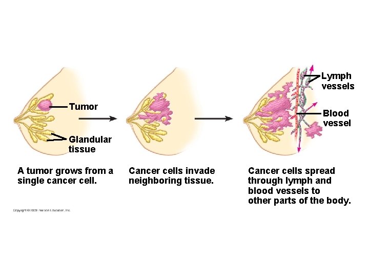 Lymph vessels Tumor Blood vessel Glandular tissue A tumor grows from a single cancer