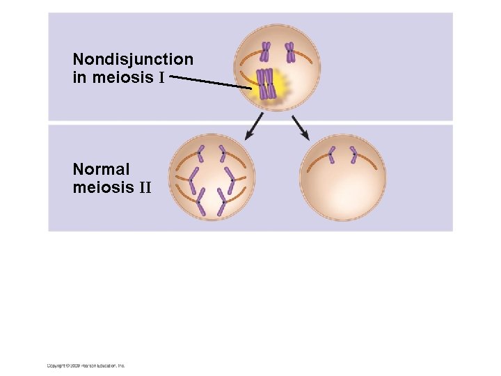 Nondisjunction in meiosis I Normal meiosis II 