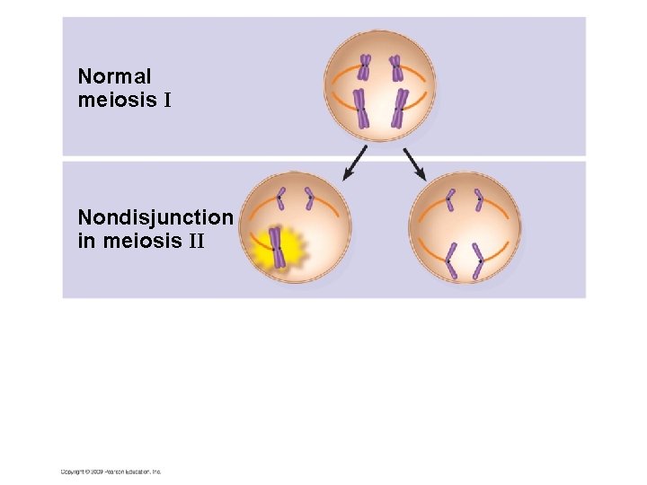 Normal meiosis I Nondisjunction in meiosis II 