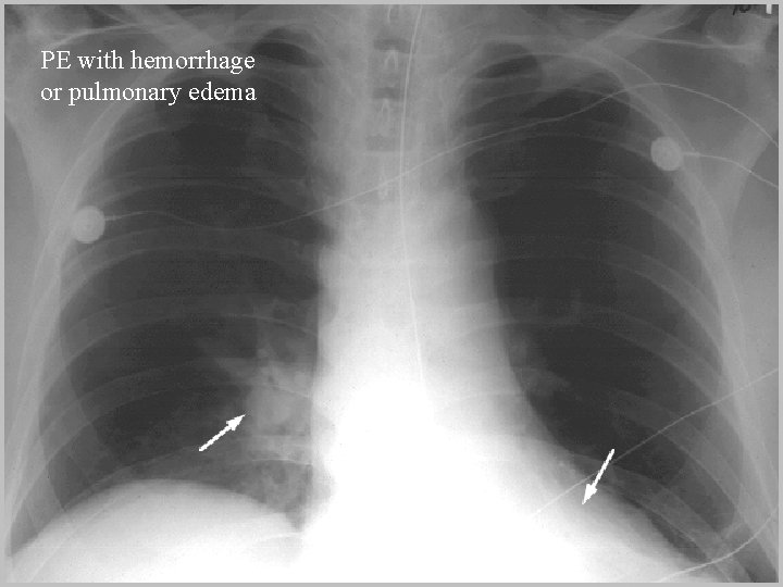 PE with hemorrhage or pulmonary edema 