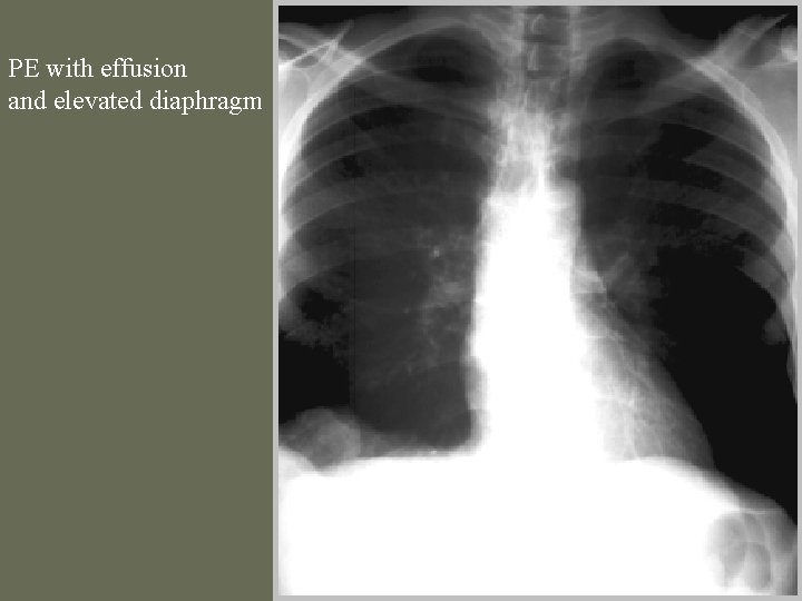 PE with effusion and elevated diaphragm 