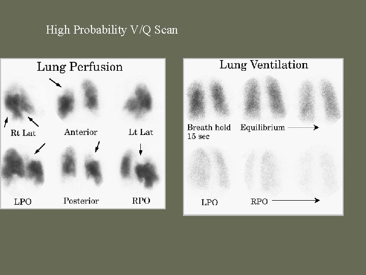 High Probability V/Q Scan 