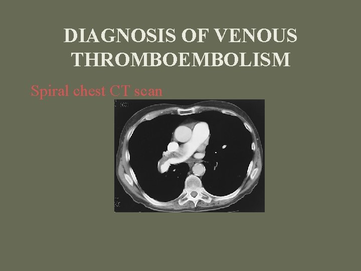 DIAGNOSIS OF VENOUS THROMBOEMBOLISM Spiral chest CT scan 