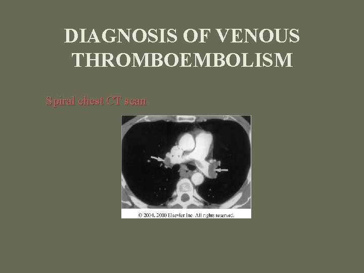 DIAGNOSIS OF VENOUS THROMBOEMBOLISM Spiral chest CT scan 