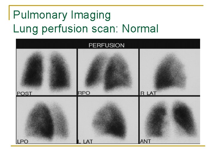 Pulmonary Imaging Lung perfusion scan: Normal 