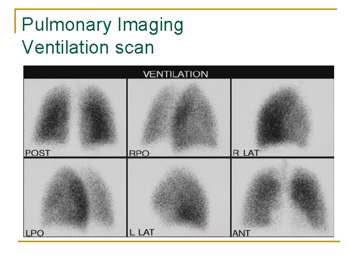 Pulmonary Imaging Ventilation scan 