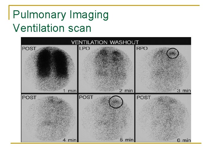 Pulmonary Imaging Ventilation scan 