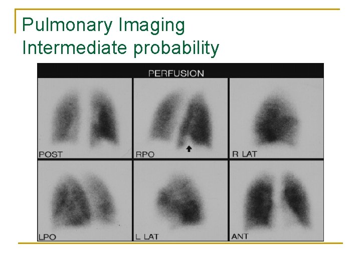 Pulmonary Imaging Intermediate probability 