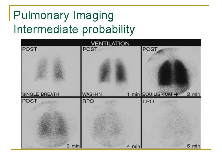 Pulmonary Imaging Intermediate probability 