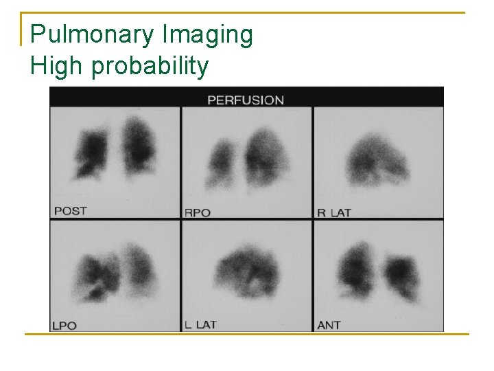 Pulmonary Imaging High probability 