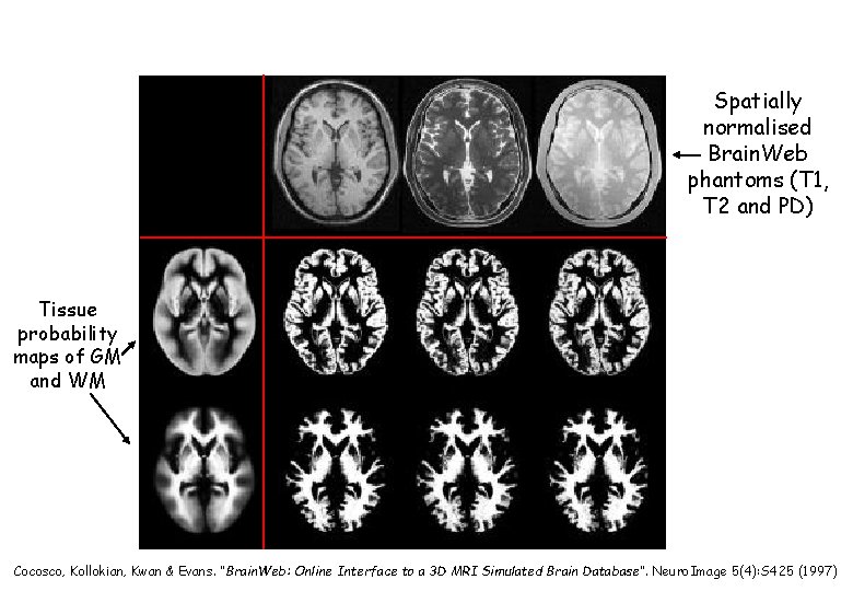 Spatially normalised Brain. Web phantoms (T 1, T 2 and PD) Tissue probability maps