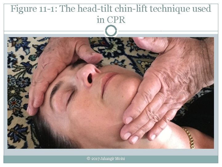 Figure 11 -1: The head-tilt chin-lift technique used in CPR © 2017 Jahangir Moini