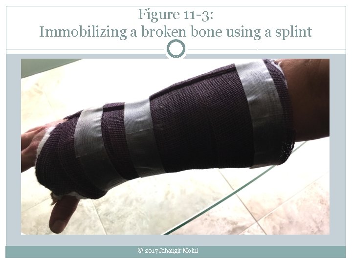 Figure 11 -3: Immobilizing a broken bone using a splint © 2017 Jahangir Moini