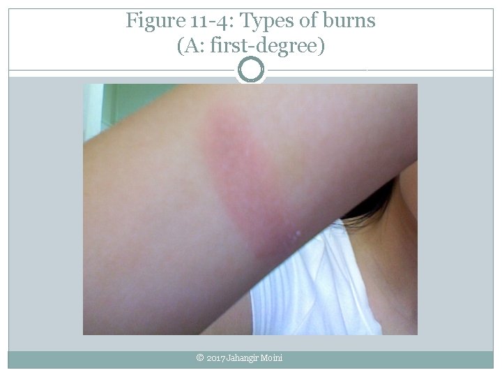 Figure 11 -4: Types of burns (A: first-degree) © 2017 Jahangir Moini Figure 11 -4: Types of burns (A: first-degree) © 2017 Jahangir Moini