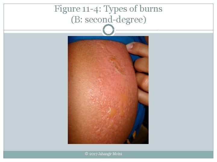 Figure 11 -4: Types of burns (B: second-degree) © 2017 Jahangir Moini 