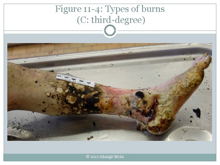 Figure 11 -4: Types of burns (C: third-degree) © 2017 Jahangir Moini 